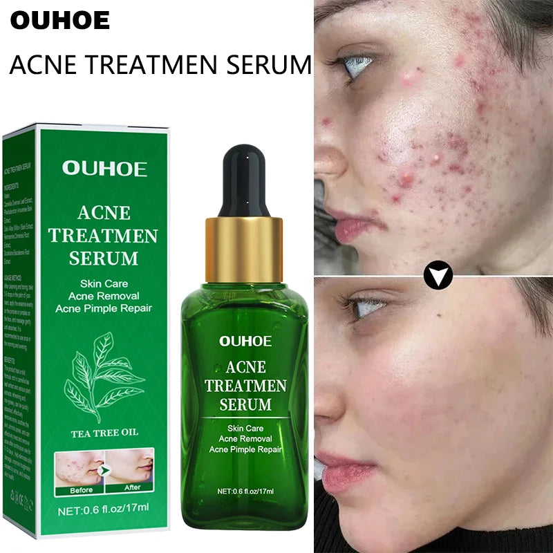 Acne Treatment Facial Serum with Tea Tree