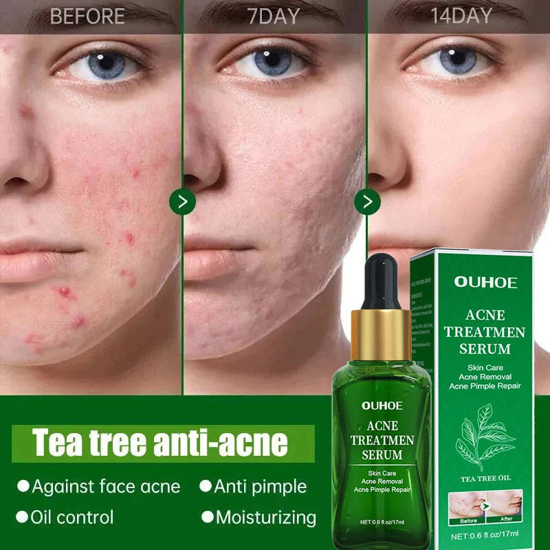 Acne Treatment Facial Serum with Tea Tree